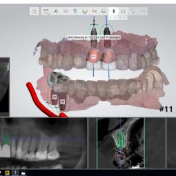 dental implant - 2