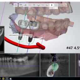 Dental Implant Dio Navi